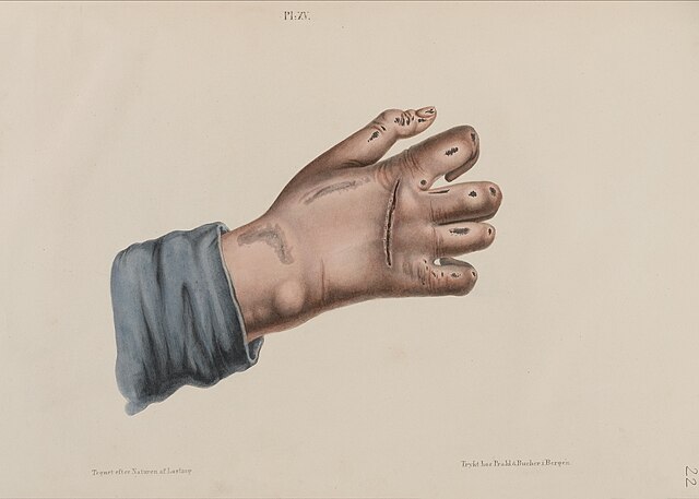 Ilustrasi Penyakit Kusta | Foto: Wikimedia Commons