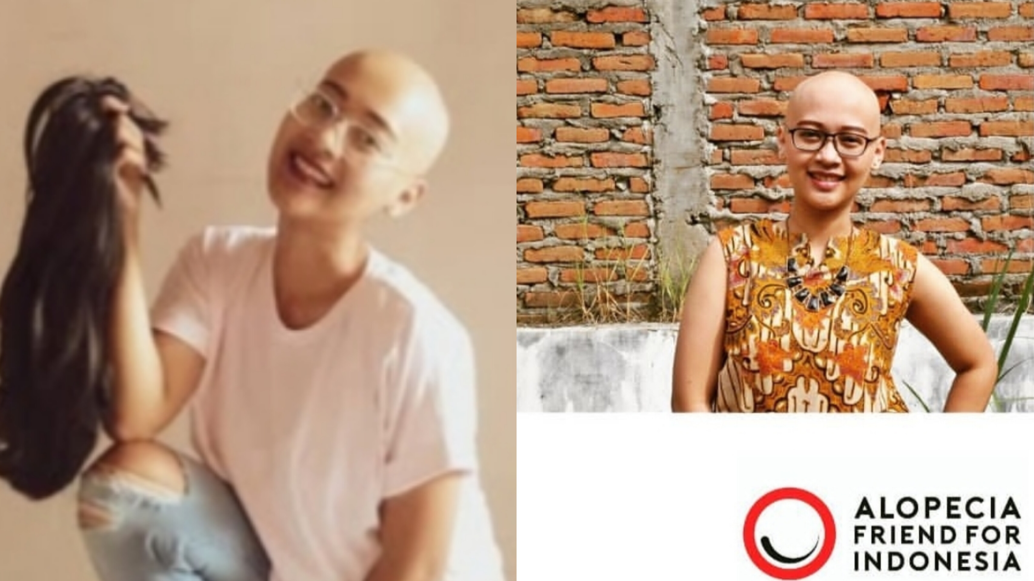 Hanna Nugrahani Setiyabudi | Foto: Instagram/@alopeciafriends