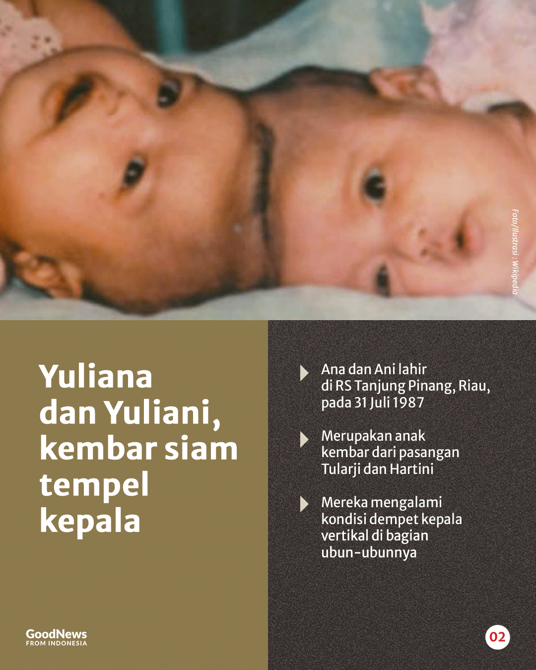 Kisah Dokter Padmosantjojo dan Operasi Bayi Kembar Siam Dempet Kepala Pertama di Indonesia