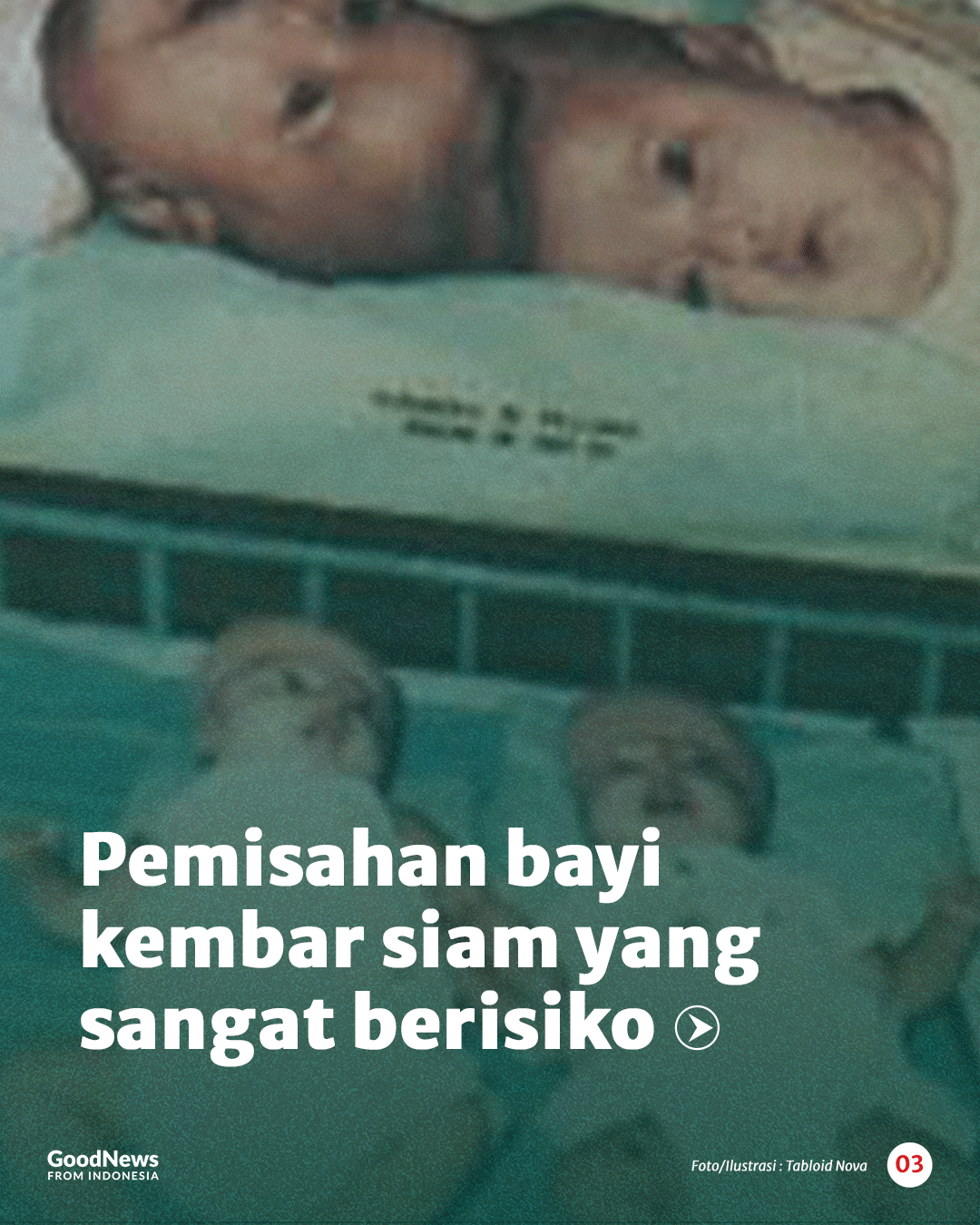 Kisah Dokter Padmosantjojo dan Operasi Bayi Kembar Siam Dempet Kepala Pertama di Indonesia