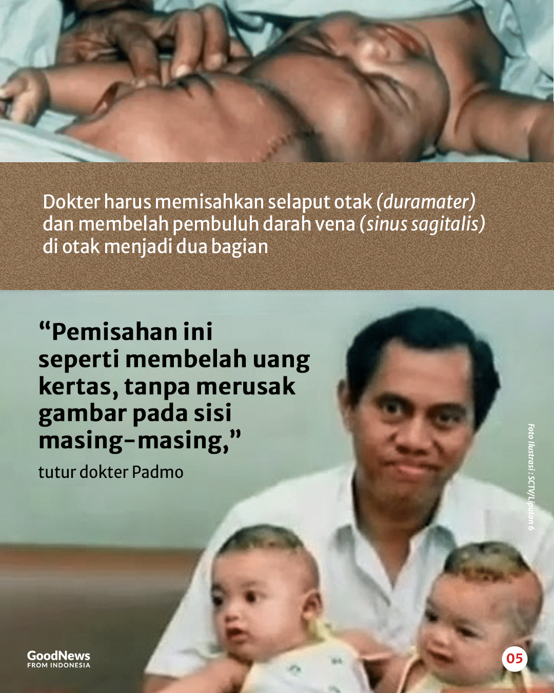 Kisah Dokter Padmosantjojo dan Operasi Bayi Kembar Siam Dempet Kepala Pertama di Indonesia