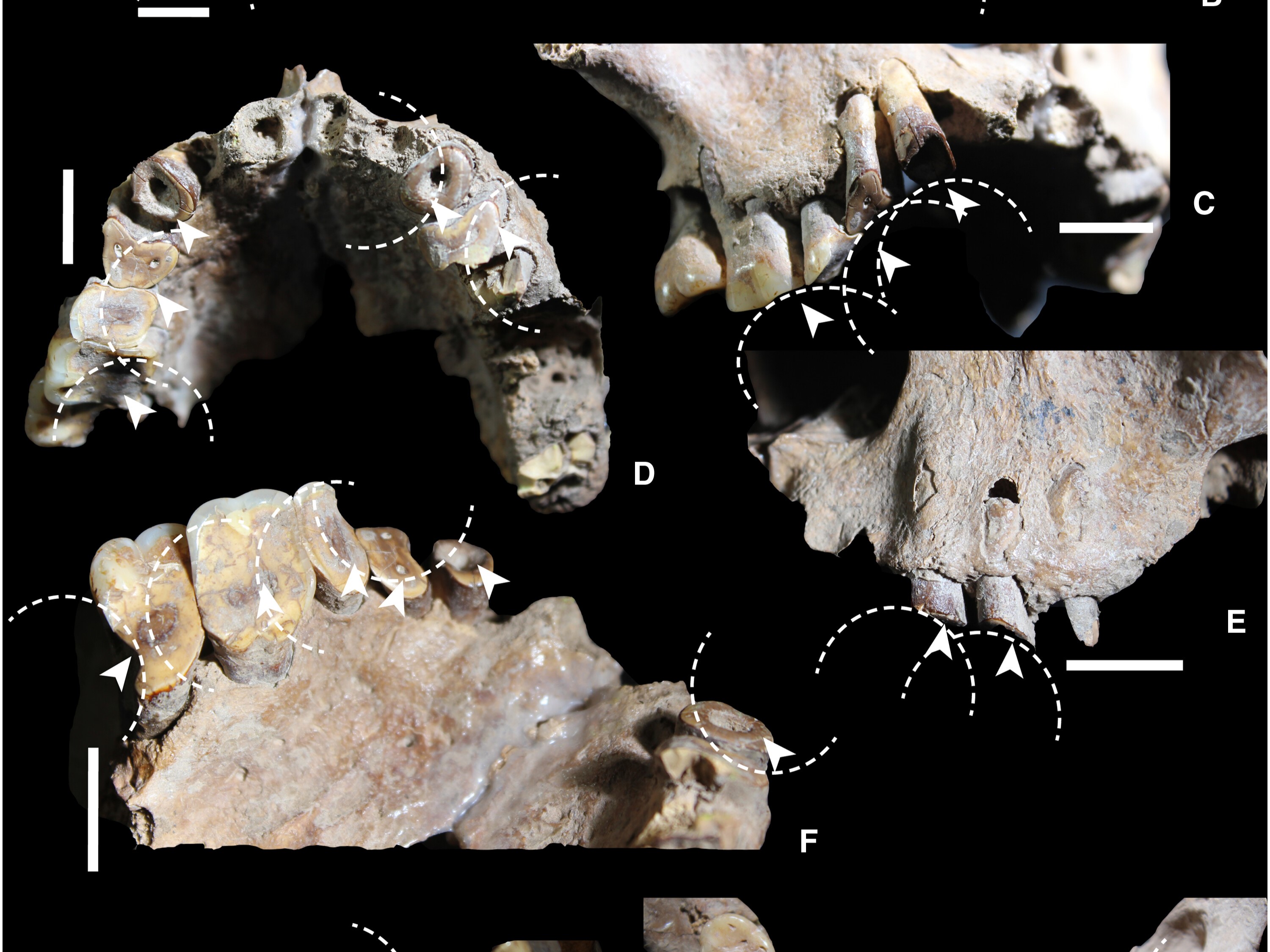 Drug use-related dental wear in early Sulawesi foragers.