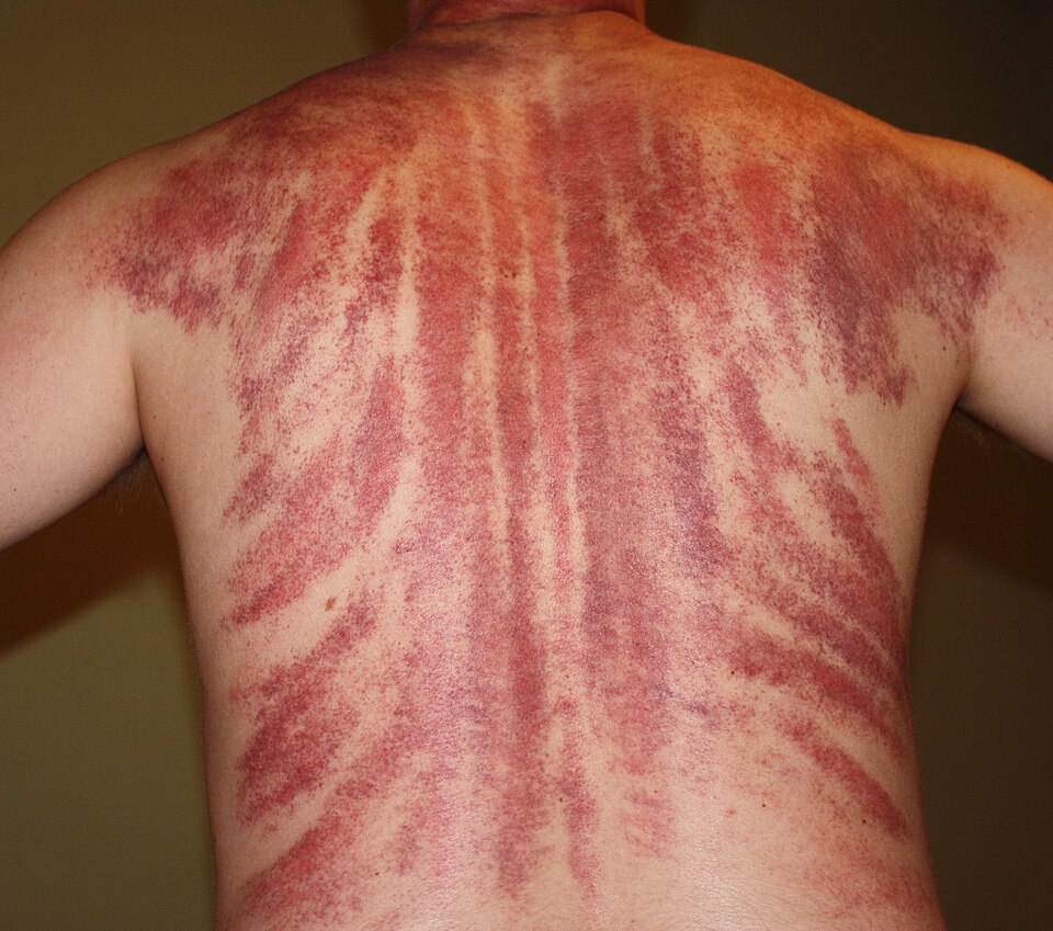 Aftermath of gua sha on a man's back | Bradwesley69/WikimediaCommons